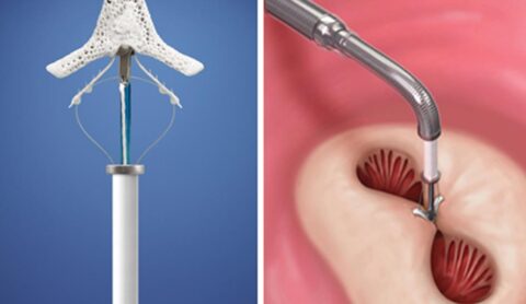Transcatheter repair with the abbott mitraclip device