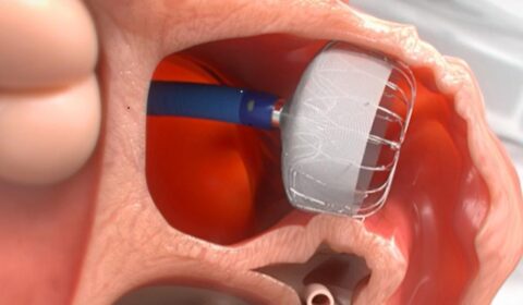 Watchman flx device by cardiac solutions