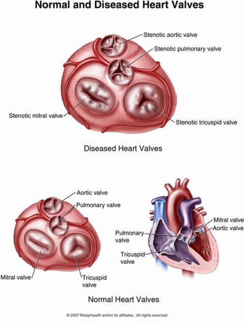 Aortic Valves Stenosis