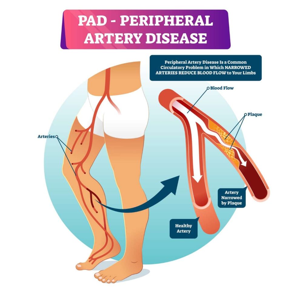 Uncomfortable Signs of Peripheral Artery Disease