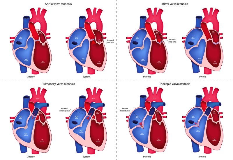 Mitral valve regurgitation diagram for heart care in Sun City, Glendale, and Peoria, AZ