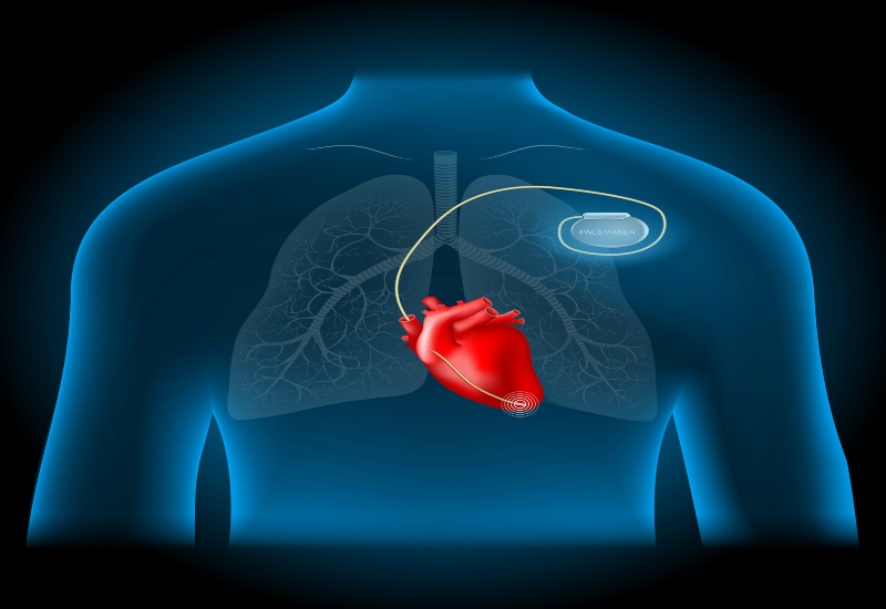 Chest diagram showing pacemaker therapy and heart support for patients in Peoria, AZ